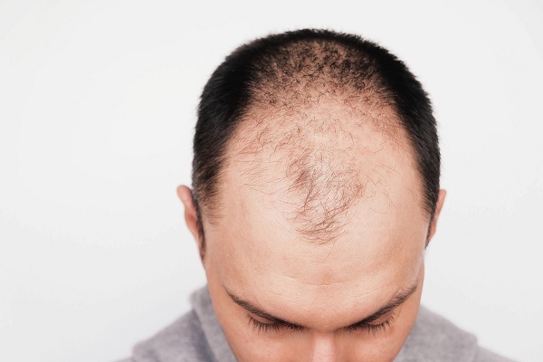 Man with male pattern baldness